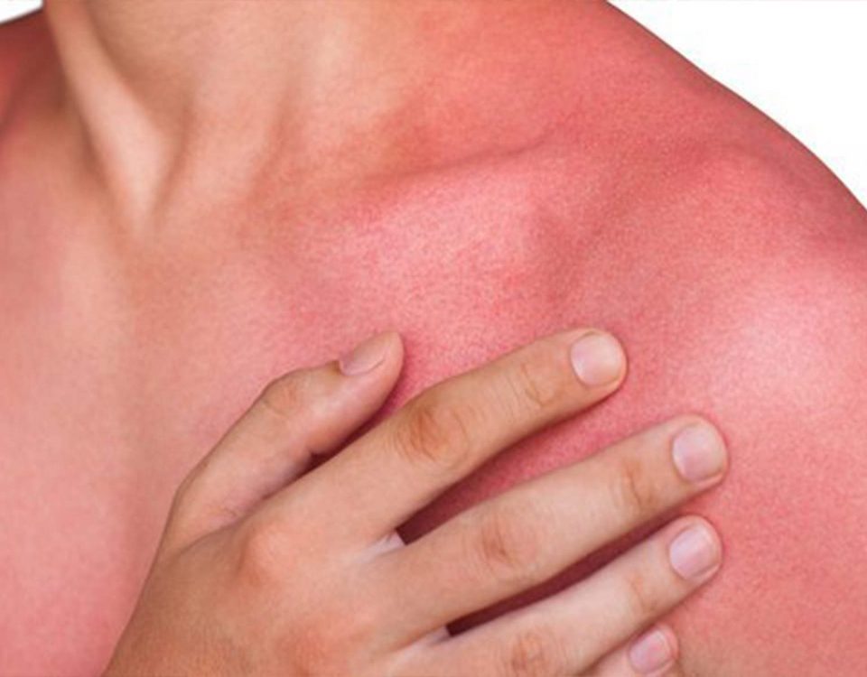 آفتاب سوختگی چیست و چگونه درمان می شود؟