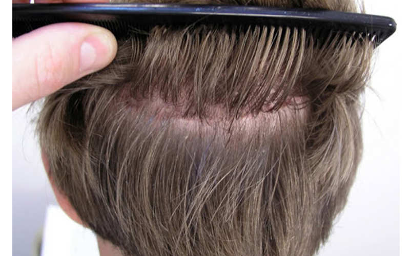 معرفی کاشت مو به روش FUT – موی وان