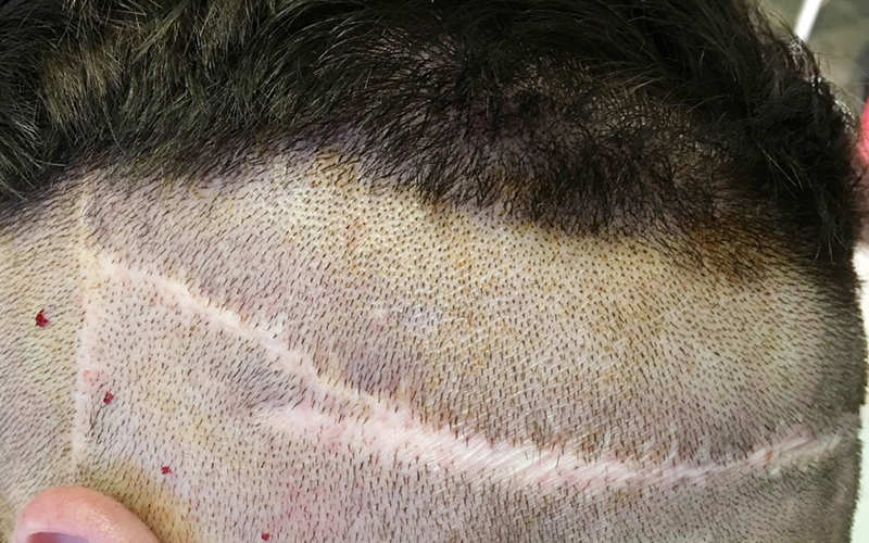معرفی کاشت مو به روش FUT – موی وان 