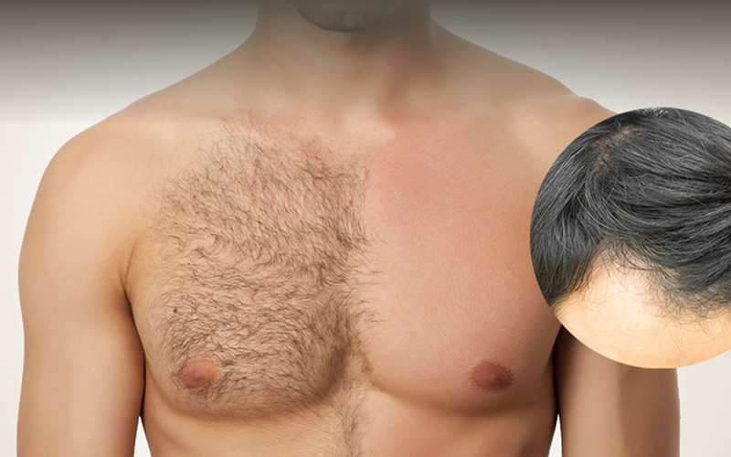 کاشت مو به روش BHT یا Body Hair Transplant  چگونه انجام می گیرد؟ - موی وان