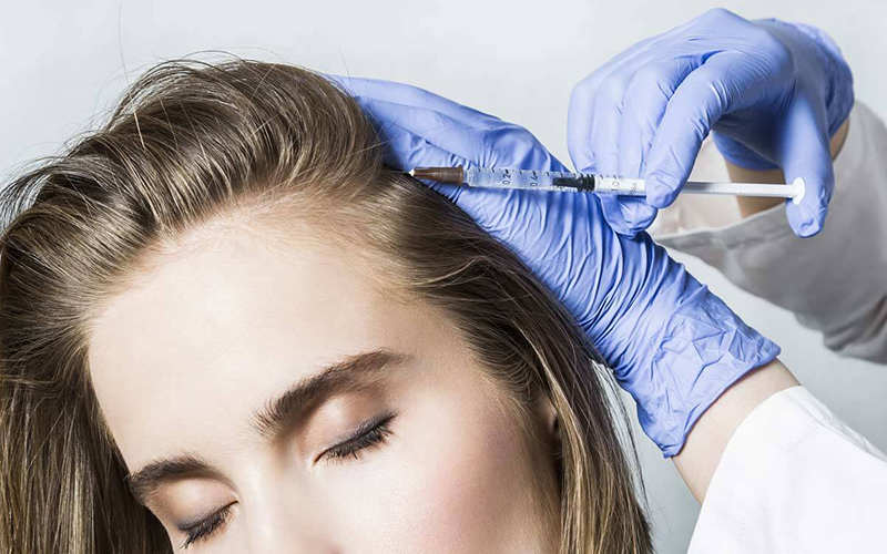 کاشت مو با استفاده از تکنیک prp چگونه انجام می گیرد؟ - موی وان