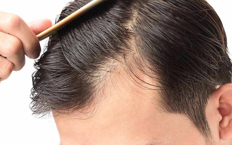 روش مزوتراپی مو چیست و چگونه انجام می گیرد؟ - موی وان