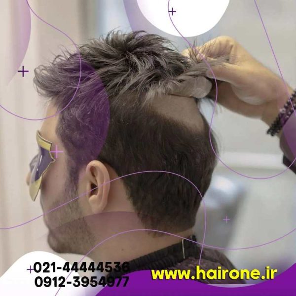 ترمیم مو روش بریدینگ-نصب پروتز مو با روش بافت-ترمیم مو-نمونه کار پروتز مو-مو وان-نصب پروتز مو-بهترین مرکز ترمیم مو در تهران