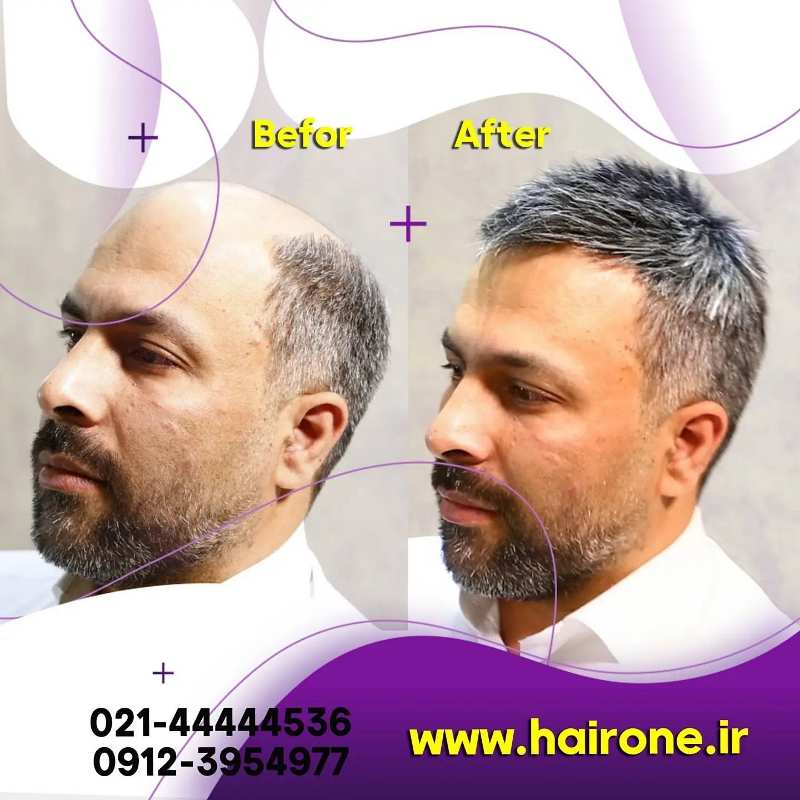 نمونه کار ترمیم مو به روش بریدینگ-نصب پروتز مو با روش بافت-ترمیم مو-نمونه کار پروتز مو-مو وان-نصب پروتز مو