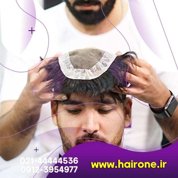 نمونه کار ترمیم مو به روش بریدینگ-نصب پروتز مو با روش بافت-ترمیم مو-نمونه کار پروتز مو-مو وان-نصب پروتز مو