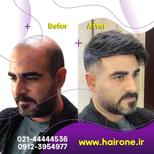 خدمات ترمیم مو-تعمیر پروتز مو-نصب پروتز مو-ترمیم مو به روش بریدینگ-نصب پروتز مو با روش بافت-ترمیم مو-نمونه کار پروتز مو-مو وان-نصب پروتز مو