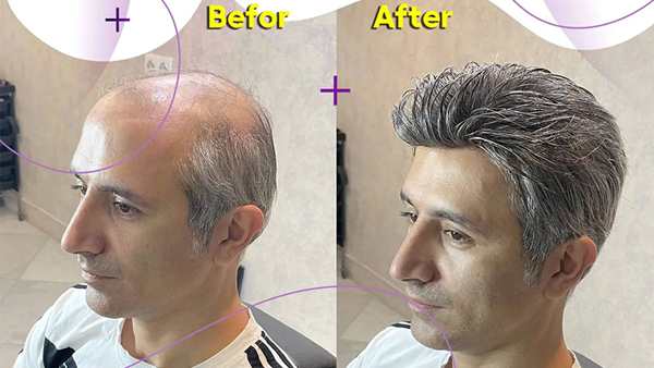پروتز مو روش بریدینگ-پروتز مو طبیعی-نصب پروتز مو با بافت-ترمیم مو وان